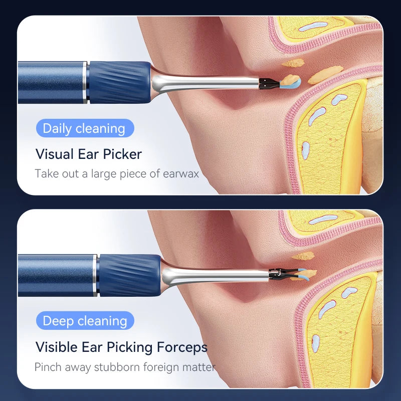 Loft Ear Wax Remoner